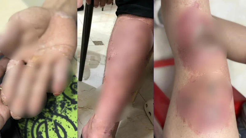 Những dấu hiệu da cảnh báo sau khi ngâm lâu trong nước ngập