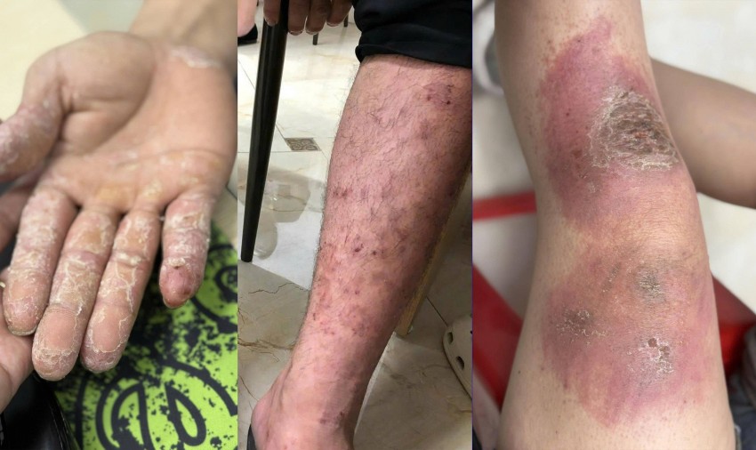 Những dấu hiệu da cảnh báo sau khi ngâm lâu trong nước ngập