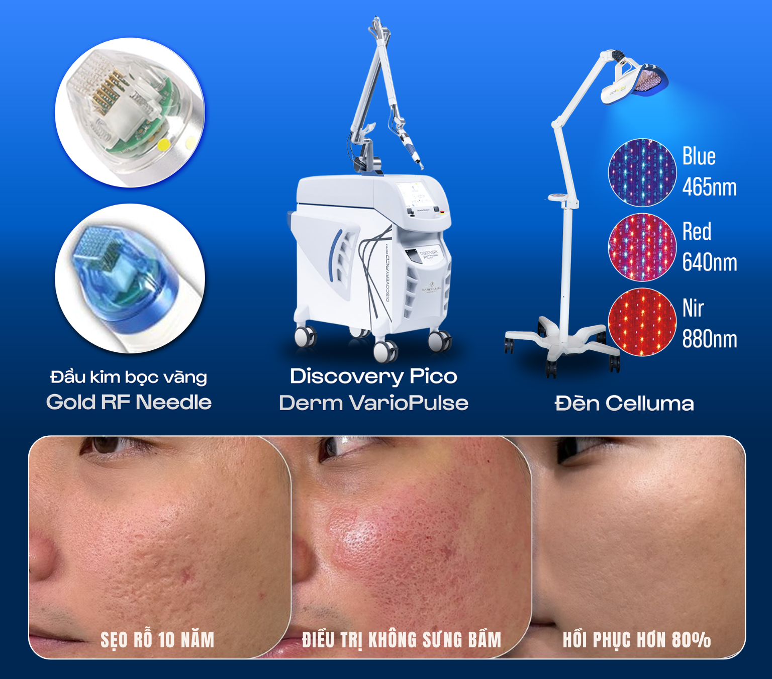 Sẹo rỗ không phải vĩnh viễn: điều trị đa tầng từ gốc rễ