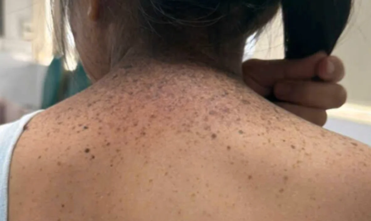 Xeroderma pigmentosum: khi ánh nắng trở thành mối đe dọa sự sống