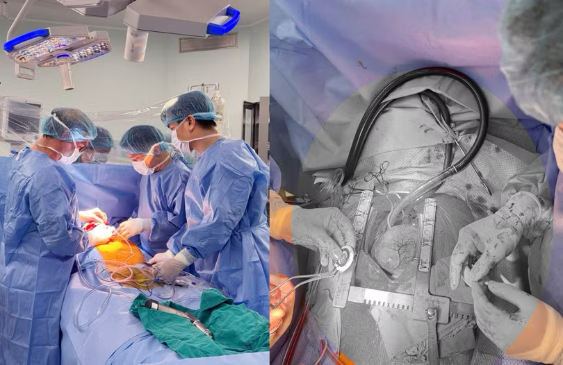 Cấy ghép trái tim cơ học CorHeart 6: bước ngoặt cho người suy tim nặng