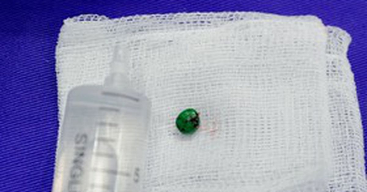 Dị vật trong tai, họng, thực quản: cha mẹ phải xử lý như cấp cứu
