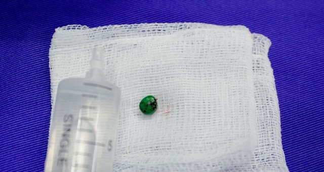 Dị vật trong tai, họng, thực quản: cha mẹ phải xử lý như cấp cứu