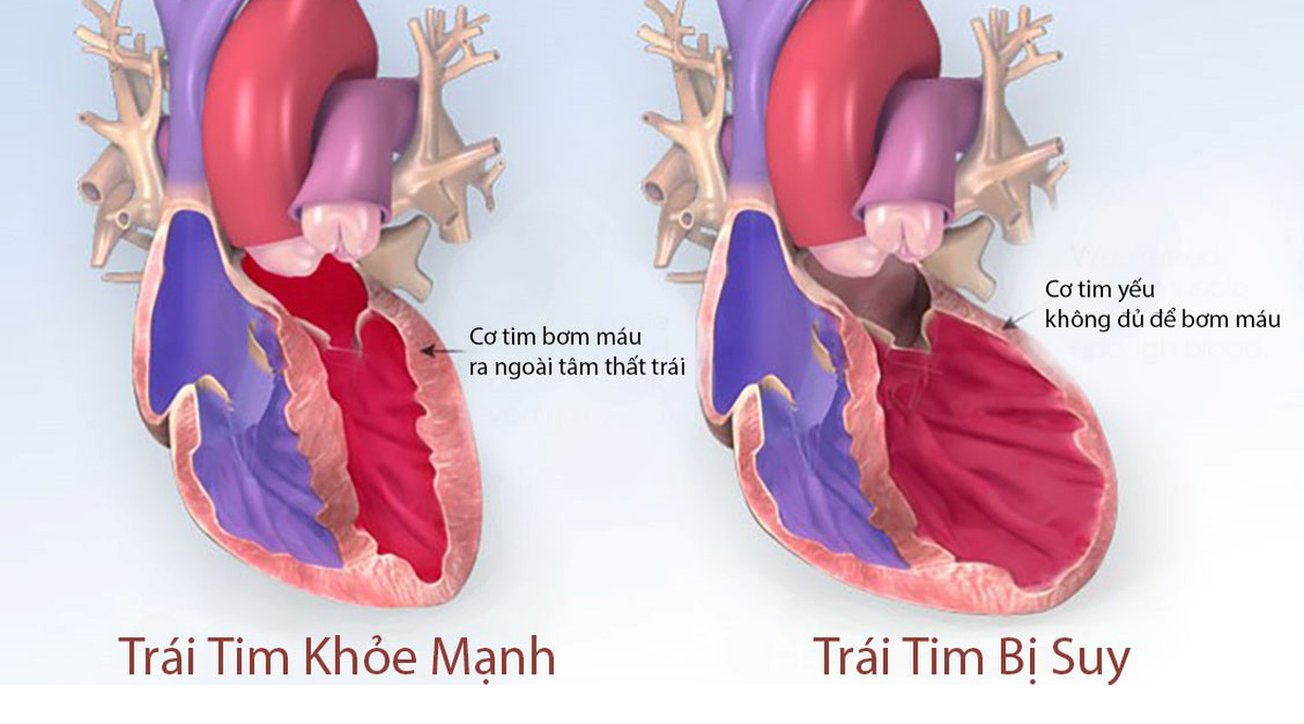 Phẫu thuật tim xâm lấn tối thiểu: cơ hội sống mới cho bệnh nhân tim bẩm sinh và suy tim nặng