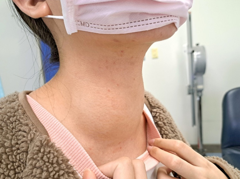 Những vệt máu lạ và chiếc cổ dày: khi dấu hiệu ung thư sớm bị bỏ qua