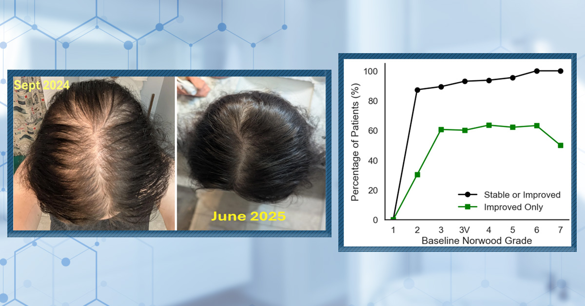 Minoxidil uống hay bôi da đầu: nên chọn hướng nào?