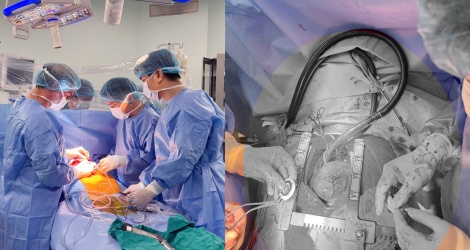 CorHeart 6: Thiết bị hỗ trợ tim mở lối mới cho bệnh nhân suy tim nặng