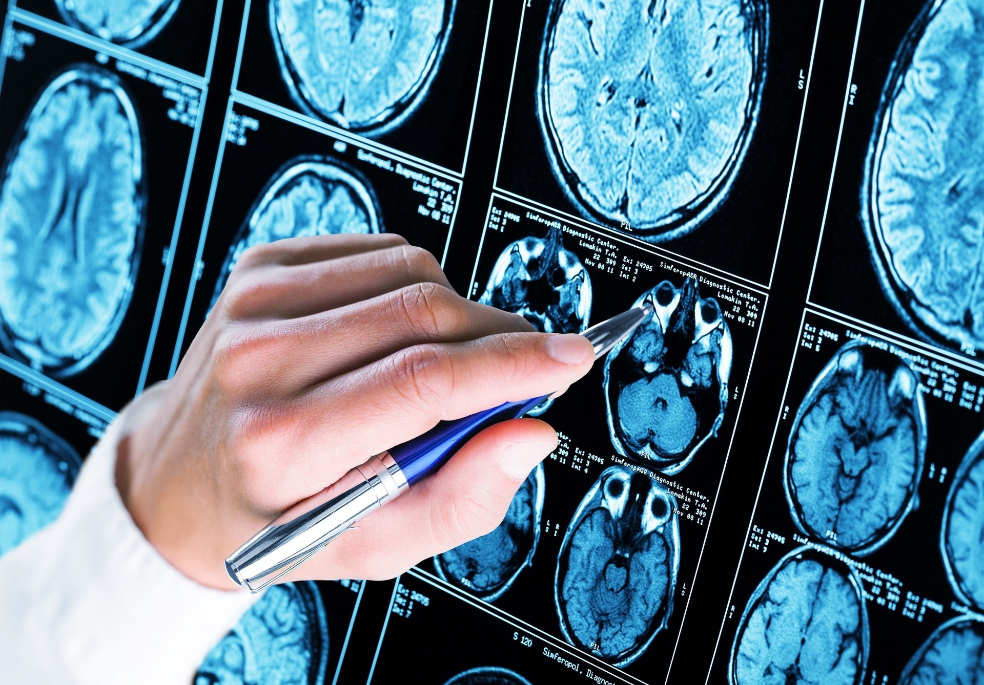 Bệnh Alzheimer không còn là số phận: từ tử thần hóa thành tình trạng có thể kiểm soát