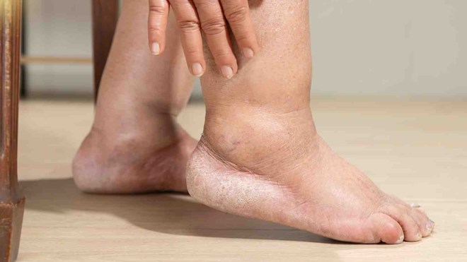 Tuổi 20–25 suy thận giai đoạn cuối: Cái giá của thức khuya và nước ngọt