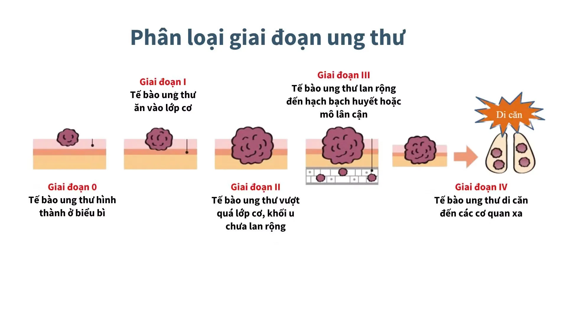 Những dấu hiệu ung thư dễ bị bỏ qua ở phụ nữ: Đừng đợi cơ thể kêu cứu