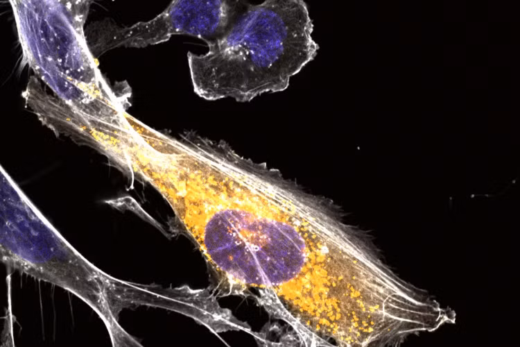 Vi protein và bản đồ gene não: bước ngoặt hy vọng cho bệnh Alzheimer