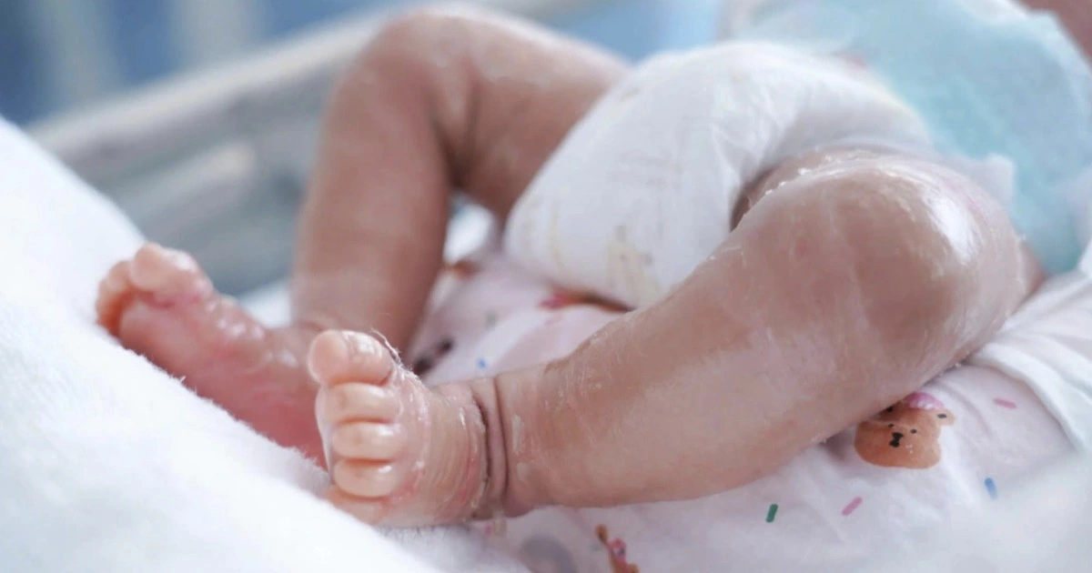Vảy cá bẩm sinh ở trẻ sơ sinh: Nhận biết sớm để cứu làn da và hơi thở của con