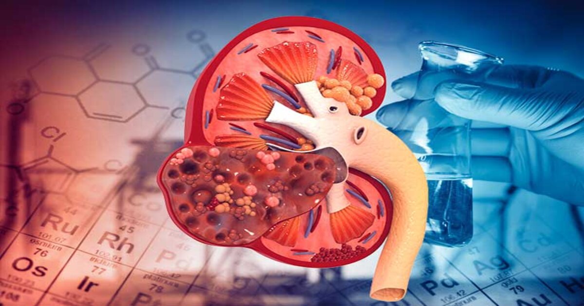Suy thận âm thầm ở tuổi 20-30: Đừng để phát hiện khi đã ở giai đoạn cuối