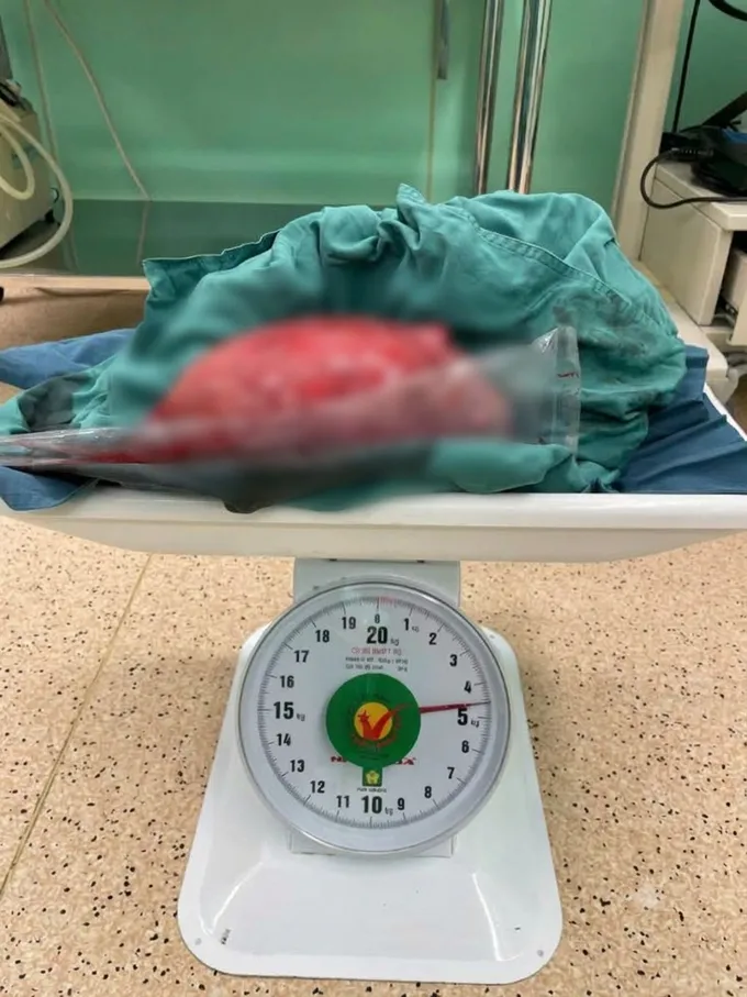 U xơ tử cung khổng lồ 4,5kg: Cái giá nguy hiểm của sự chần chừ