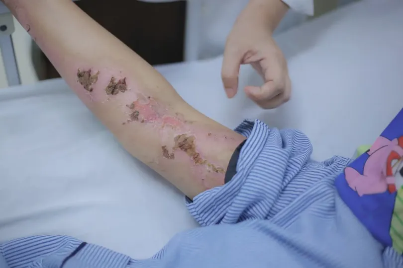 Bị sét đánh giữa đường: Nhận diện sớm, sơ cứu đúng để giữ mạng sống