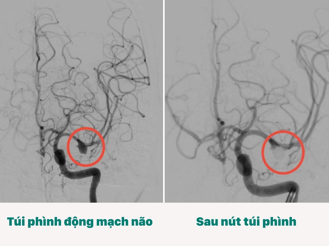 Những phút sinh tử trong vỡ phình mạch máu: từ can thiệp nội mạch đến phẫu thuật khẩn cấp