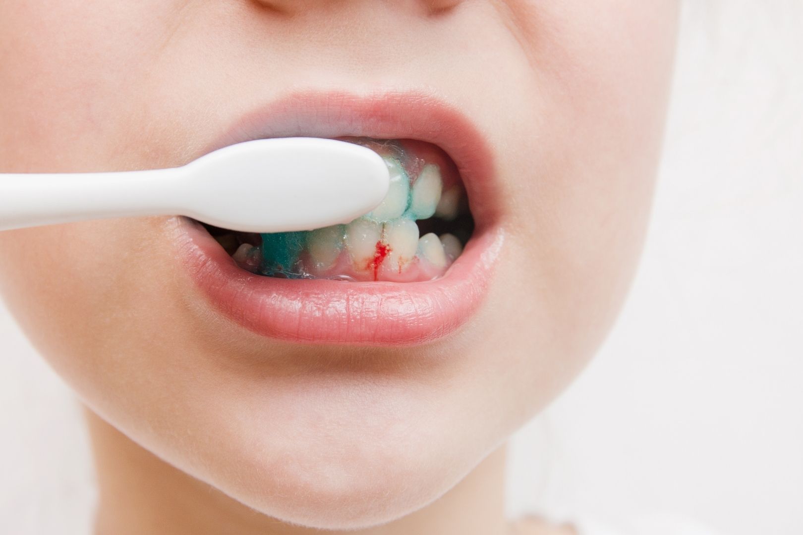 Chảy máu lợi và 4 dấu hiệu viêm nha chu khác không nên bỏ qua