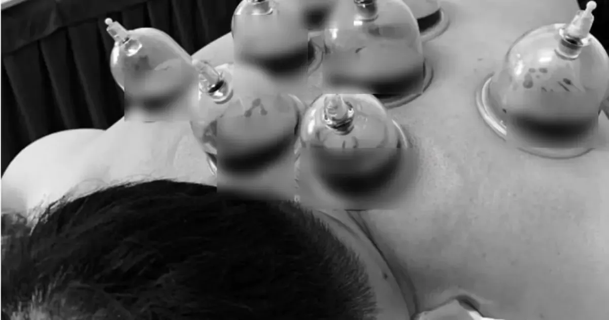 Chích máu, giác hơi không chữa đột quỵ: Ảo tưởng nguy hiểm trên mạng xã hội