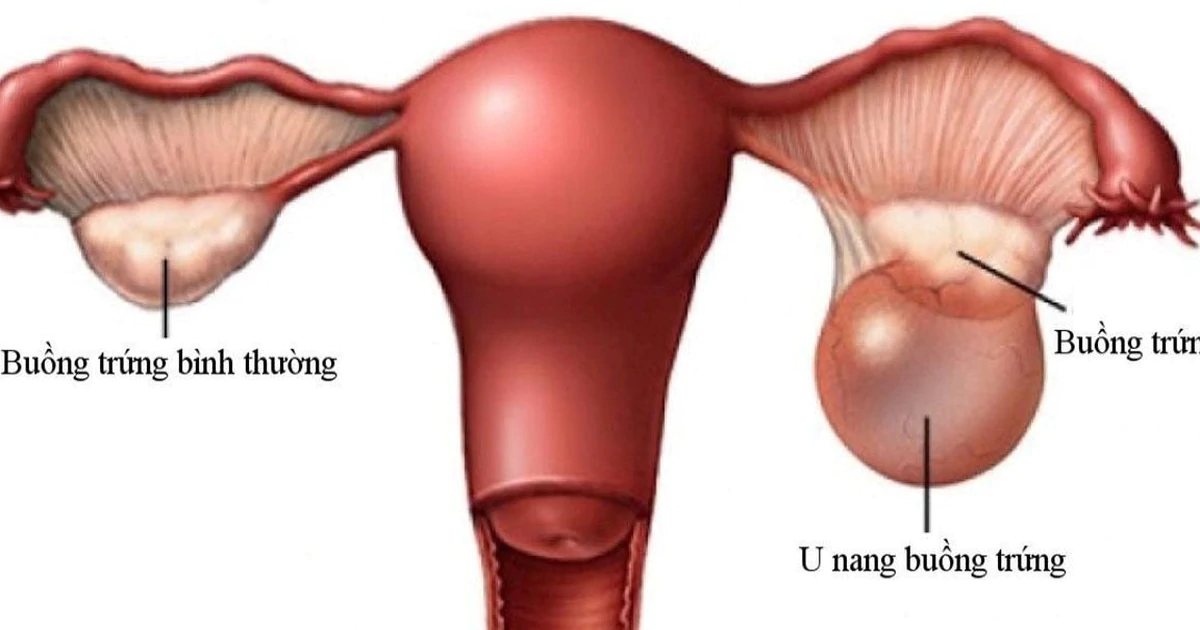 U xơ tử cung: Nhận diện sớm và điều trị khôn ngoan