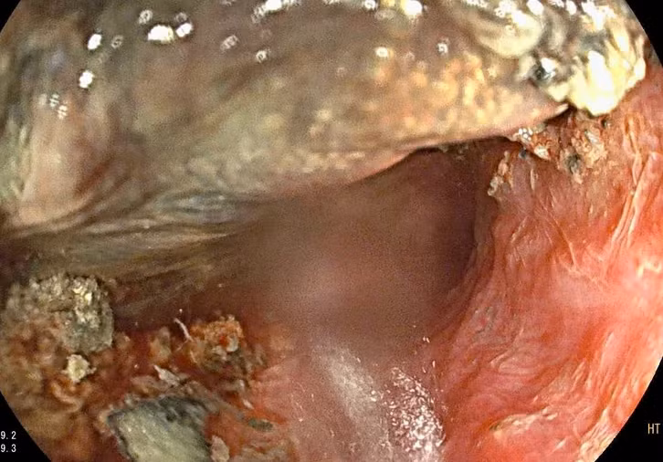 Những dị vật nguy hiểm ẩn trong nhà và cách cha mẹ phản ứng kịp thời