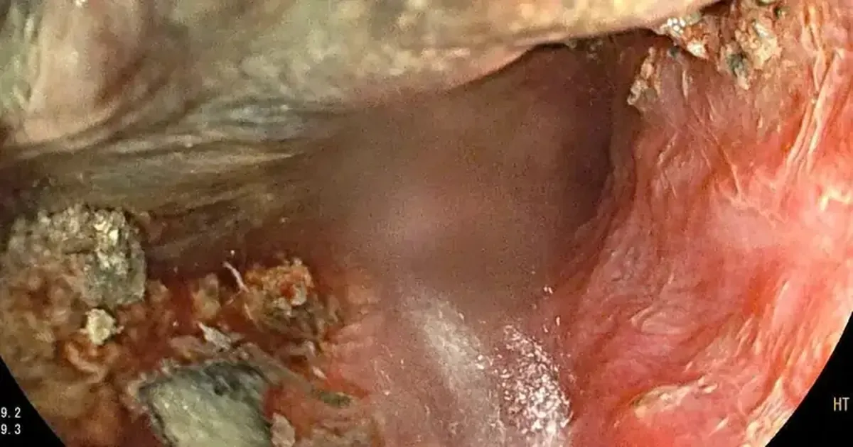 Đồ chơi bóp mềm và pin cúc áo: Cảnh báo khẩn cho cha mẹ