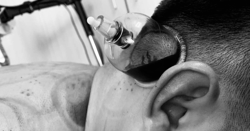 Giác hơi chích máu không cứu được đột quỵ và còn cướp mất thời gian vàng