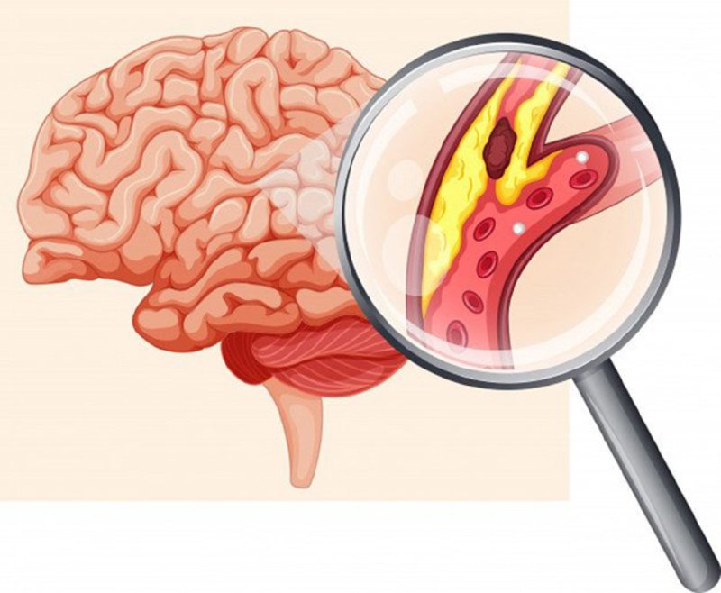Sau đột quỵ: Phục hồi chức năng và chiến lược phòng tái phát