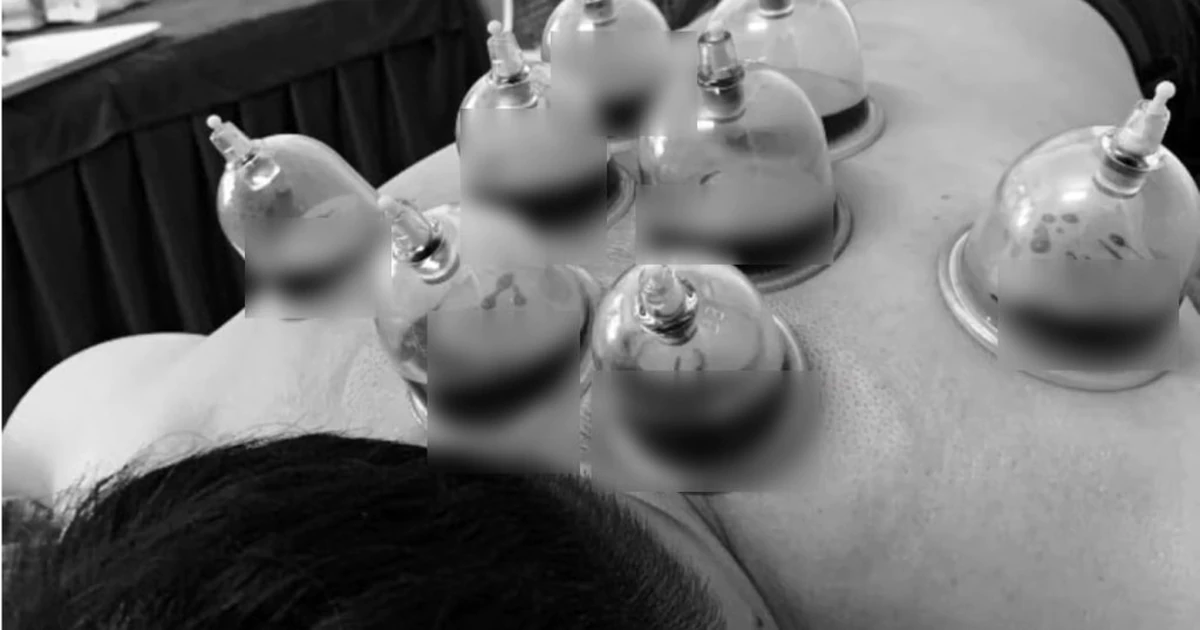 Giác hơi, chích máu không cứu được đột quỵ
