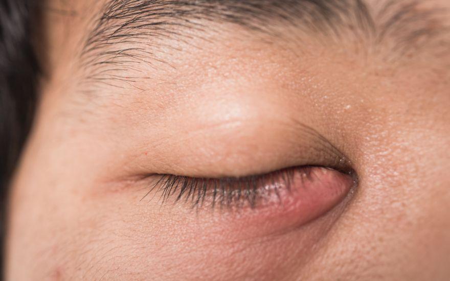 Mụn quanh mắt cảnh báo bệnh gì và cách xử lý an toàn