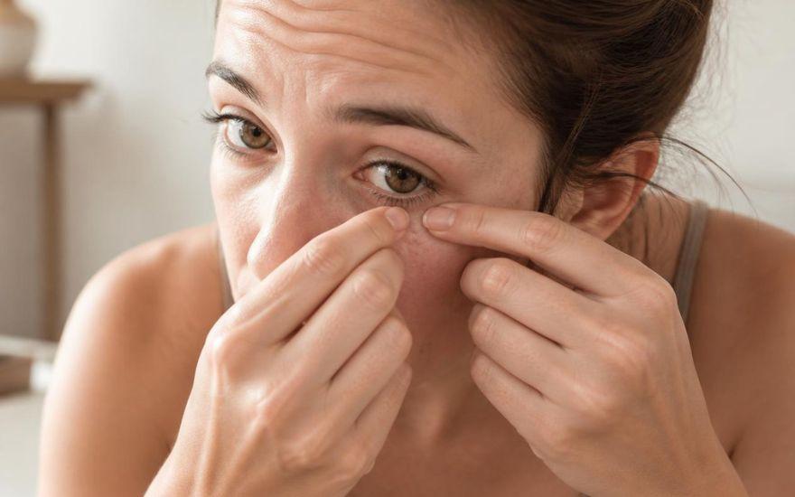 Mụn quanh mắt cảnh báo bệnh gì và cách xử lý an toàn