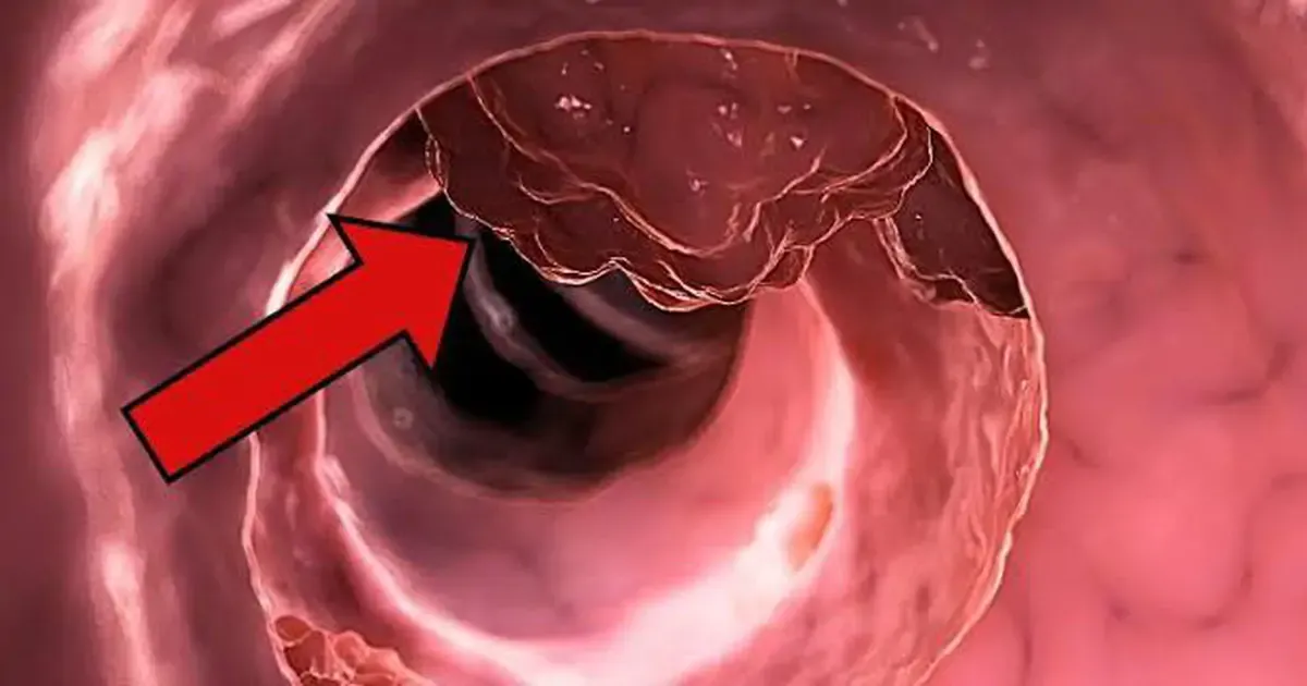 Ung thư khởi phát sớm ở người trẻ: Đừng đợi đến khi cơ thể kêu cứu
