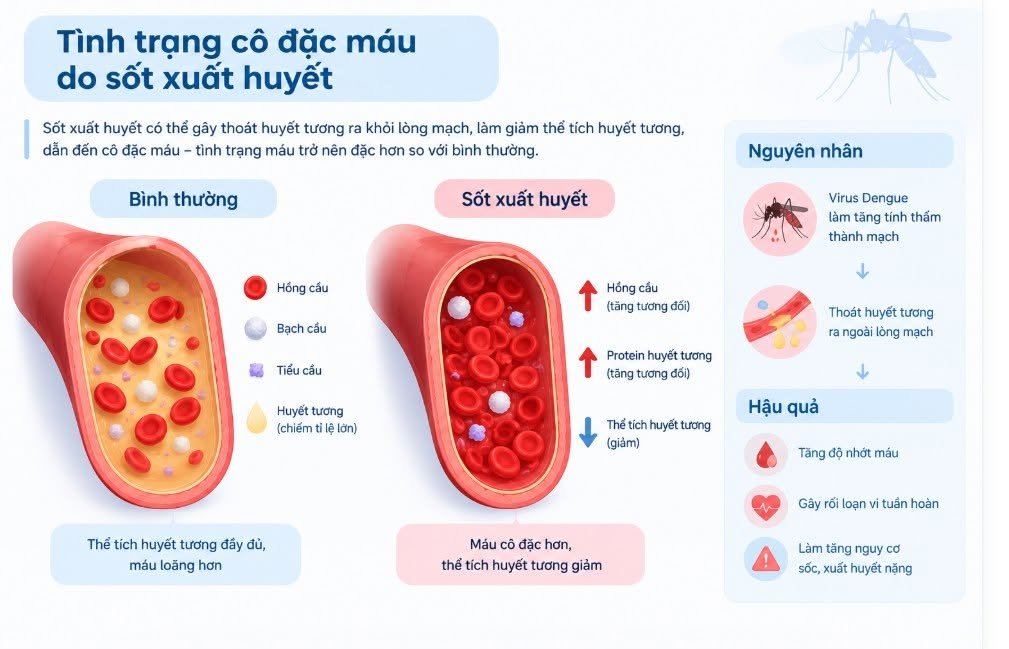 Sốt xuất huyết không phải lúc nào cũng rõ ràng: Đừng để giai đoạn hạ sốt đánh lừa bạn