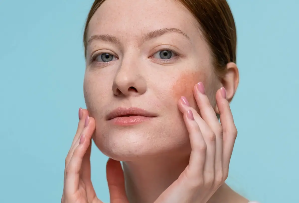 Hàng rào ẩm da bị tổn thương: gốc rễ viêm da nhạy cảm và rosacea