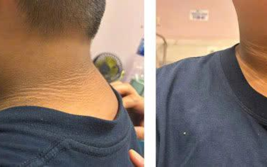 Khám sức khỏe định kỳ hé lộ đái tháo đường tuổi vị thành niên