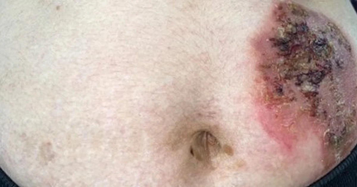 Phối hợp liệu pháp sinh học với điều trị tại chỗ trong pemphigus
