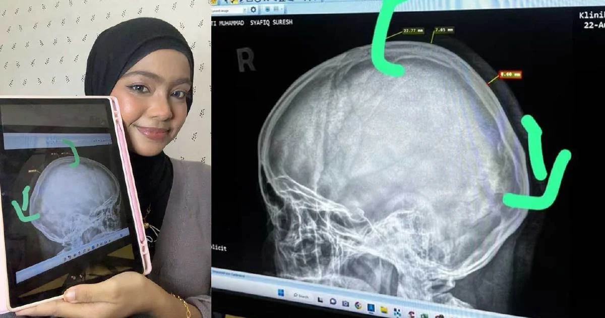 Bahaya Tersembunyi Klip Cakar pada Kulit Kepala