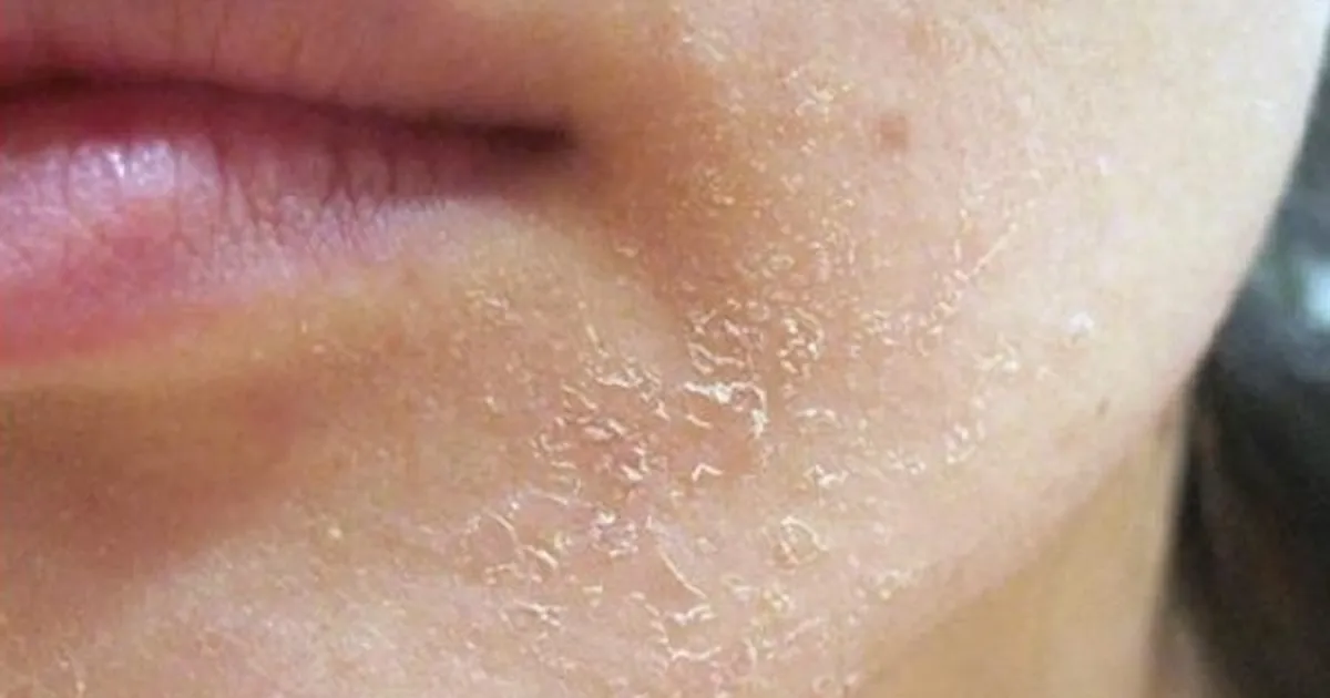 Cách chọn lotion dưỡng ẩm cho da dầu mụn mà không gây kích ứng