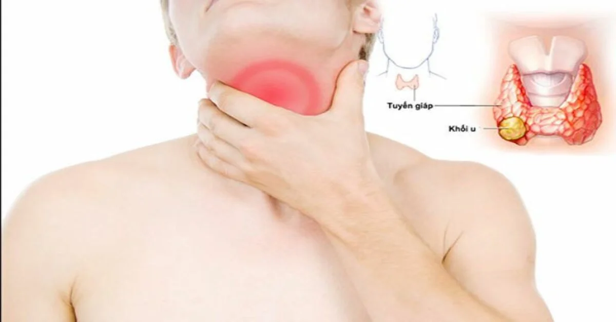 Khi một người trong gia đình mắc ung thư tuyến giáp