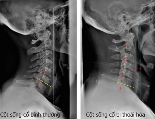 Thoái hóa cột sống cổ vẫn tập được: Hướng dẫn bài tập an toàn tại nhà và phòng gym