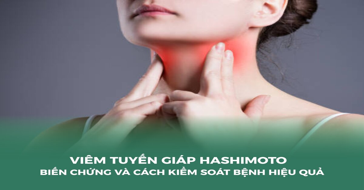 Viêm tuyến giáp Hashimoto: Nhận diện sớm trước khi quá muộn