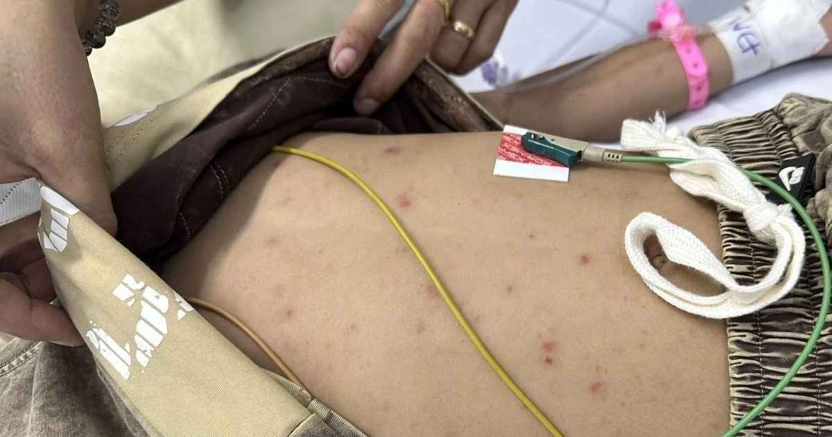 Não mô cầu diễn tiến trong vài giờ: Vì sao vaccine phải đi trước điều trị