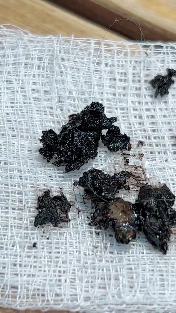 Ketulan kotoran telinga hitam kering di atas kain kasa putih selepas dikeluarkan dari telinga kucing