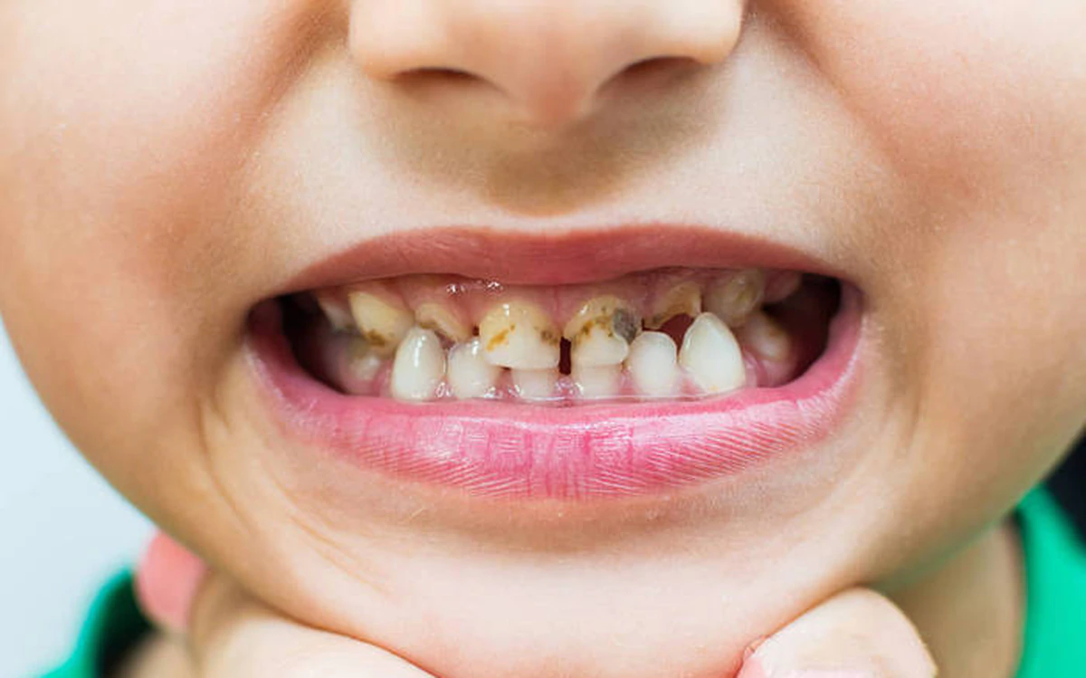 Não mô cầu ở trẻ em: Nhận biết nguy cấp và gọi cấp cứu ngay