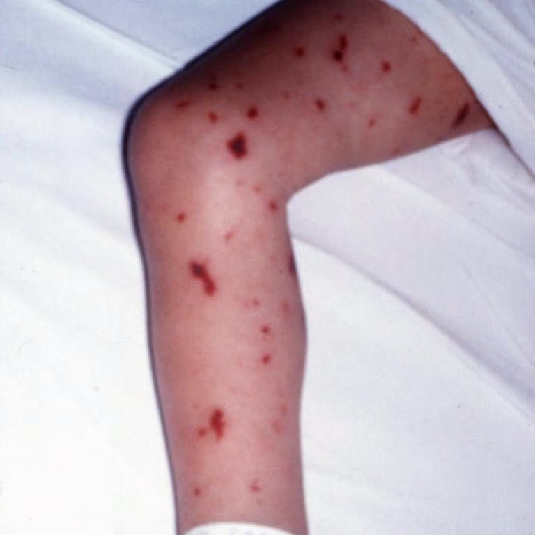 Não mô cầu diễn tiến trong vài giờ: nhận diện sớm để giữ cơ hội sống