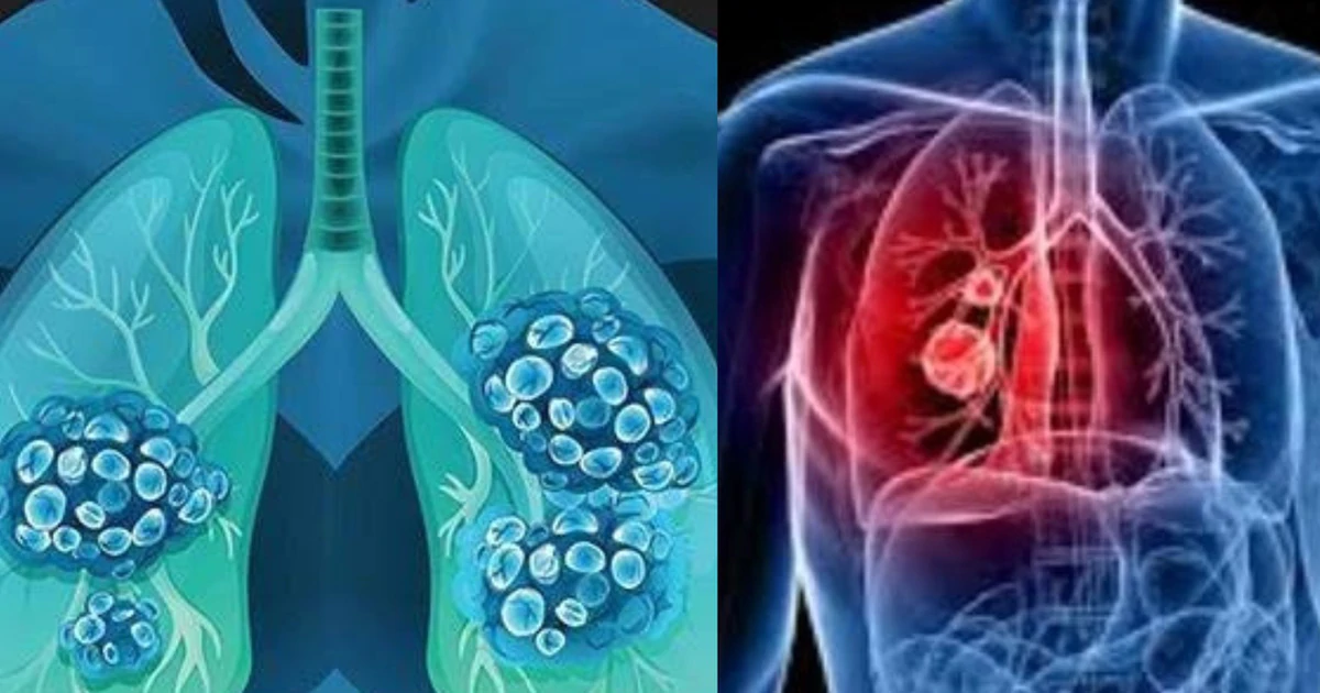 Những dấu hiệu ung thư dễ nhầm với bệnh thông thường và cách nhận biết