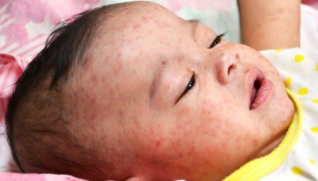 Hai dấu hiệu não mô cầu phụ huynh không nên bỏ qua