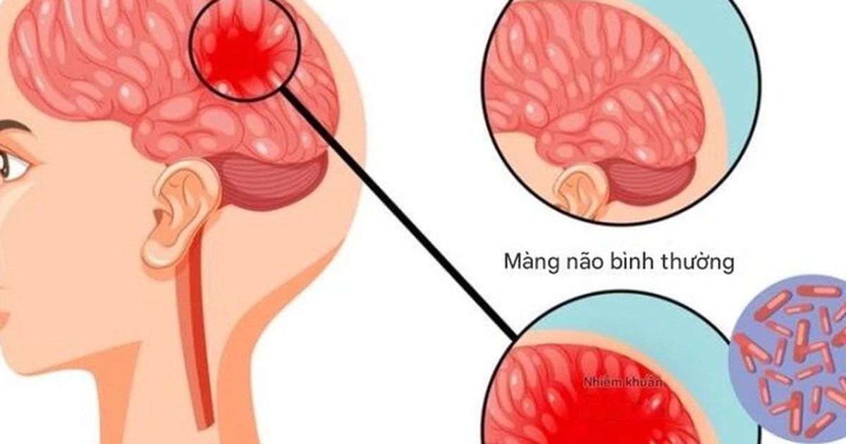 Dấu hiệu não mô cầu: Nhận biết sớm, xử trí kịp thời