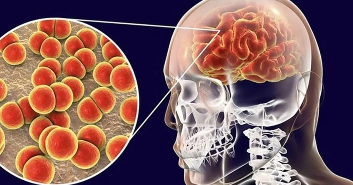 Bệnh não mô cầu có thể trở nặng trong vài giờ: Nhận biết dấu hiệu và cách phòng ngừa