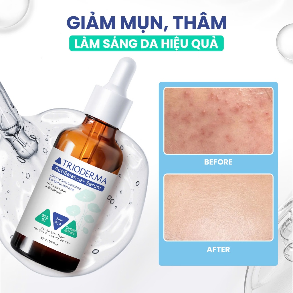 Serum hỗ trợ cải thiện mụn làm dịu dưỡng da Trioderma ActiBalance+ 30ml